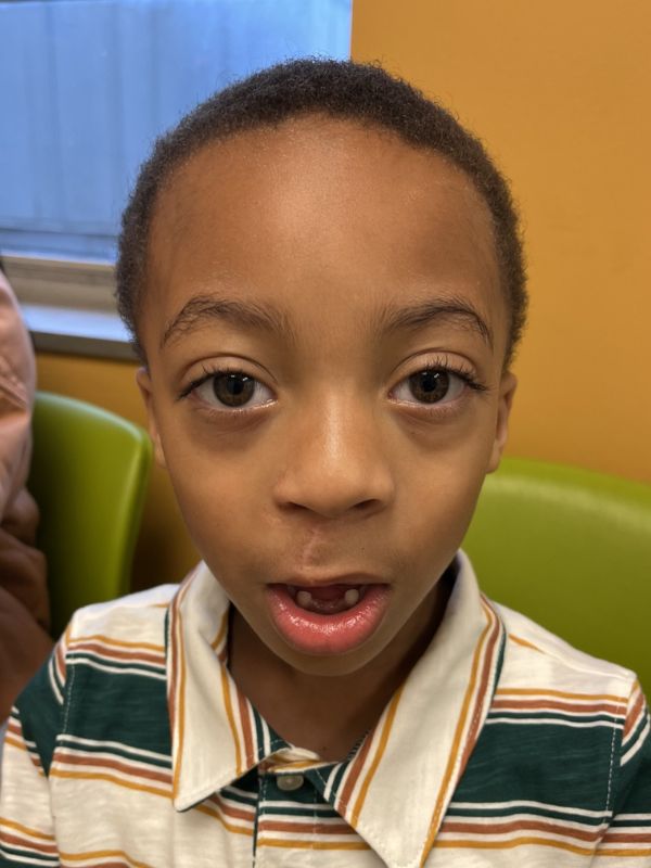 A boy who has been treated for cleft lip